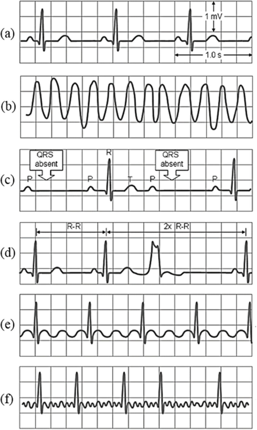 Common examples of abnormal ECGs 11 a normal sinus rhythm b ventricular