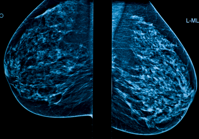 mammography 1 thumb s